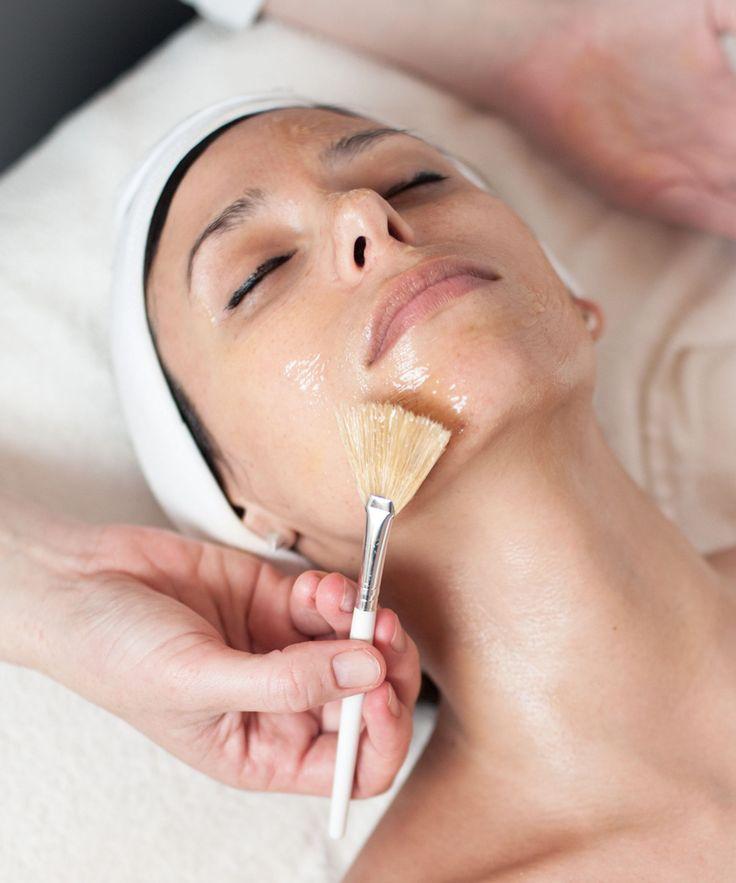Chemical Peels