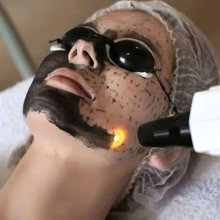 Laser Carbon Peel