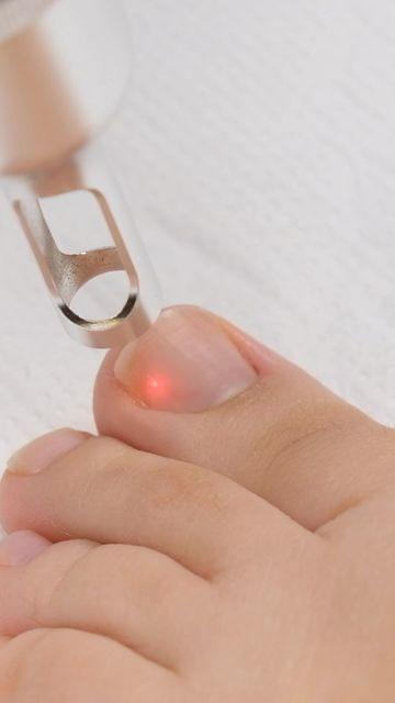 Laser fungal nail