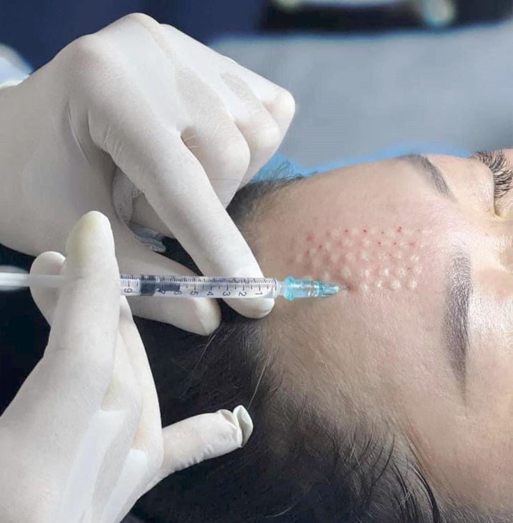 mesotherapy near me in Surrey